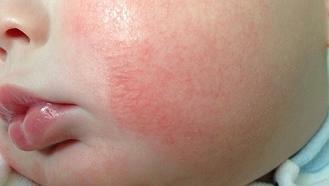 Atopični dermatitis pri otrocih