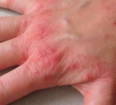 Eczema on the hands