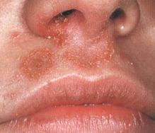 Staphylococcus v nosní fotografii