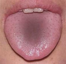 graue Beschichtung auf der Zunge