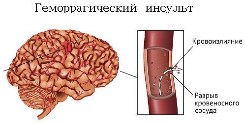Hemorragisk hjerneslag forårsaker