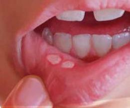التهاب الفم القلاعي