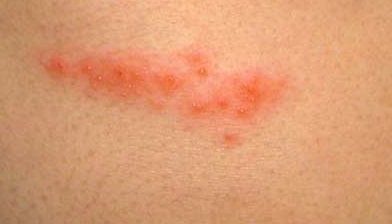 Shingles in a person: photos, symptoms and treatment