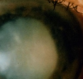 Simptomi glaukoma
