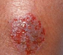 Eczema microbico