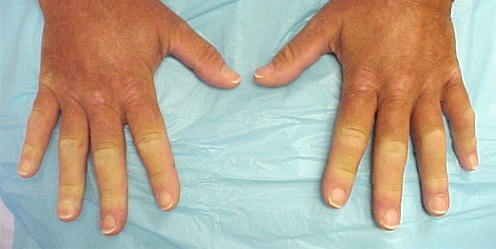 Raynauds sykdomsbehandling