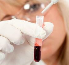 Povečana sečna kislina v krvi