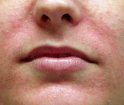 Seboroická dermatitída na tvári