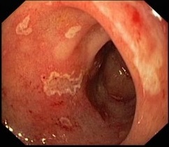 Simptomi erozivnih gastritisa