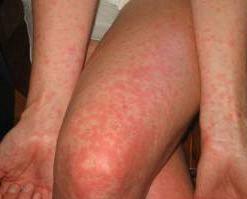 small red rash on the legs