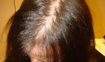 alopecija pri ženskah