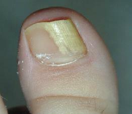 how to treat nail fungus on legs
