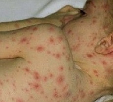 Qué manchar de varicela en niños