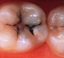 príznaky zubného kazu