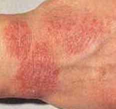 Eczema on the hands of the symptoms
