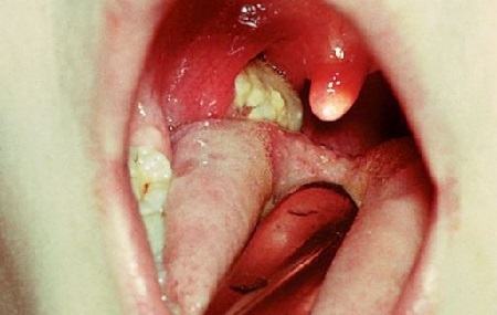 Difterie van de oropharynx, gelokaliseerde vorm. Vlezige coating op de linker tonsil.
