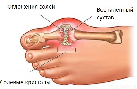 Gout - symptoms and treatment at home