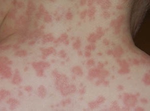 Comment l'allergie se manifeste-t-elle après les antibiotiques?