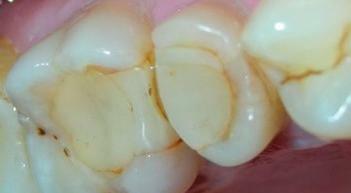 skausmas dantis po pripildymo