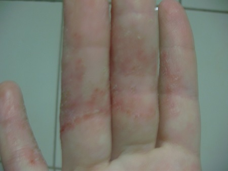 Eczema on the hands of the initial stage