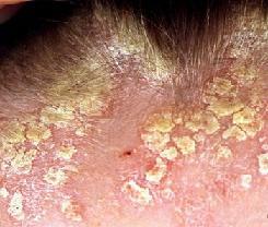 psoriasis på hovedet Foto