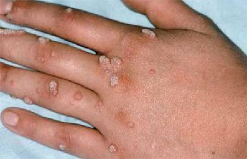 Príznaky ľudského papilomavírusu