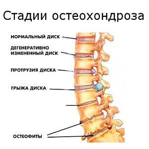 Como tratar a osteocondrose da coluna vertebral