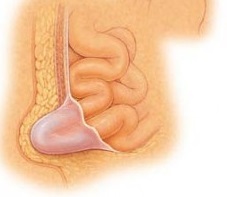 Umbilical hernia treatment