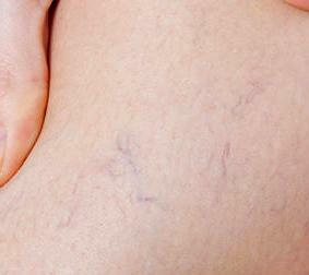 Kŕčové žily na nohách: príznaky a liečba