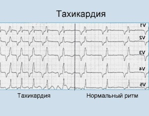 Tahikardija povzroča