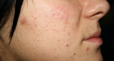 L'acné sur le visage