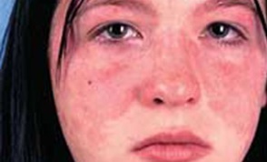 Systémové príznaky lupus erythematosus