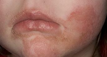 Symptom på atopisk dermatit