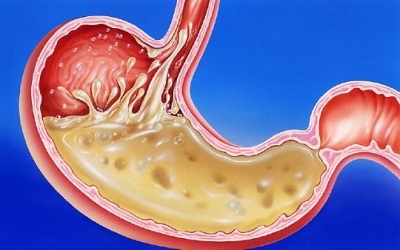 Povečana kislost želodca - simptomi in zdravljenje