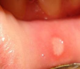 Aftosny أعراض التهاب الفم