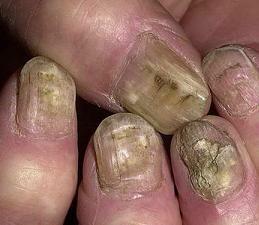 grzyb paznokci