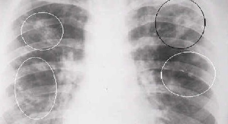 Tuberculosis de los pulmones en adultos: síntomas y tratamiento