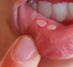 Wrzody w jamie ustnej