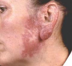 photo de peau de tuberculose