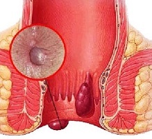 Hemorrhoids in the initial stage - symptoms, prevention and treatment