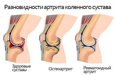 Artritis de las articulaciones de la rodilla
