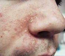 أعراض التهاب الجلد الزهمي