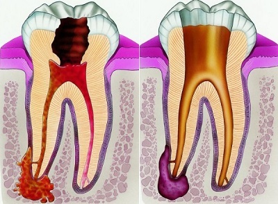 Simptomi periododontije